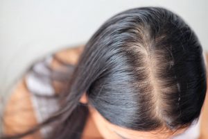 Τριχόπτωση: Ποιες είναι οι αποτελεσματικές θεραπείες;
